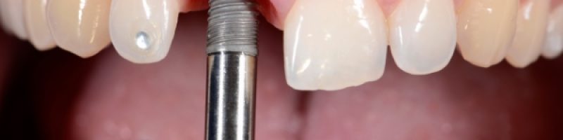 ניתוח השתלת שיניים